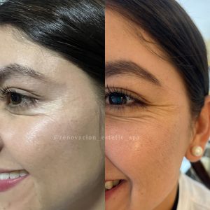 Aplicación de Toxina Botulinica (botox)